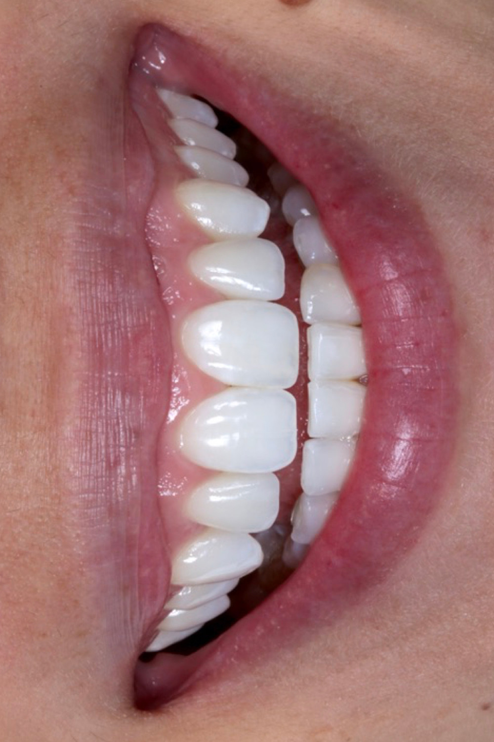 Lentes de contato dentais. Daniel Malta Dentista Florianópolis.
