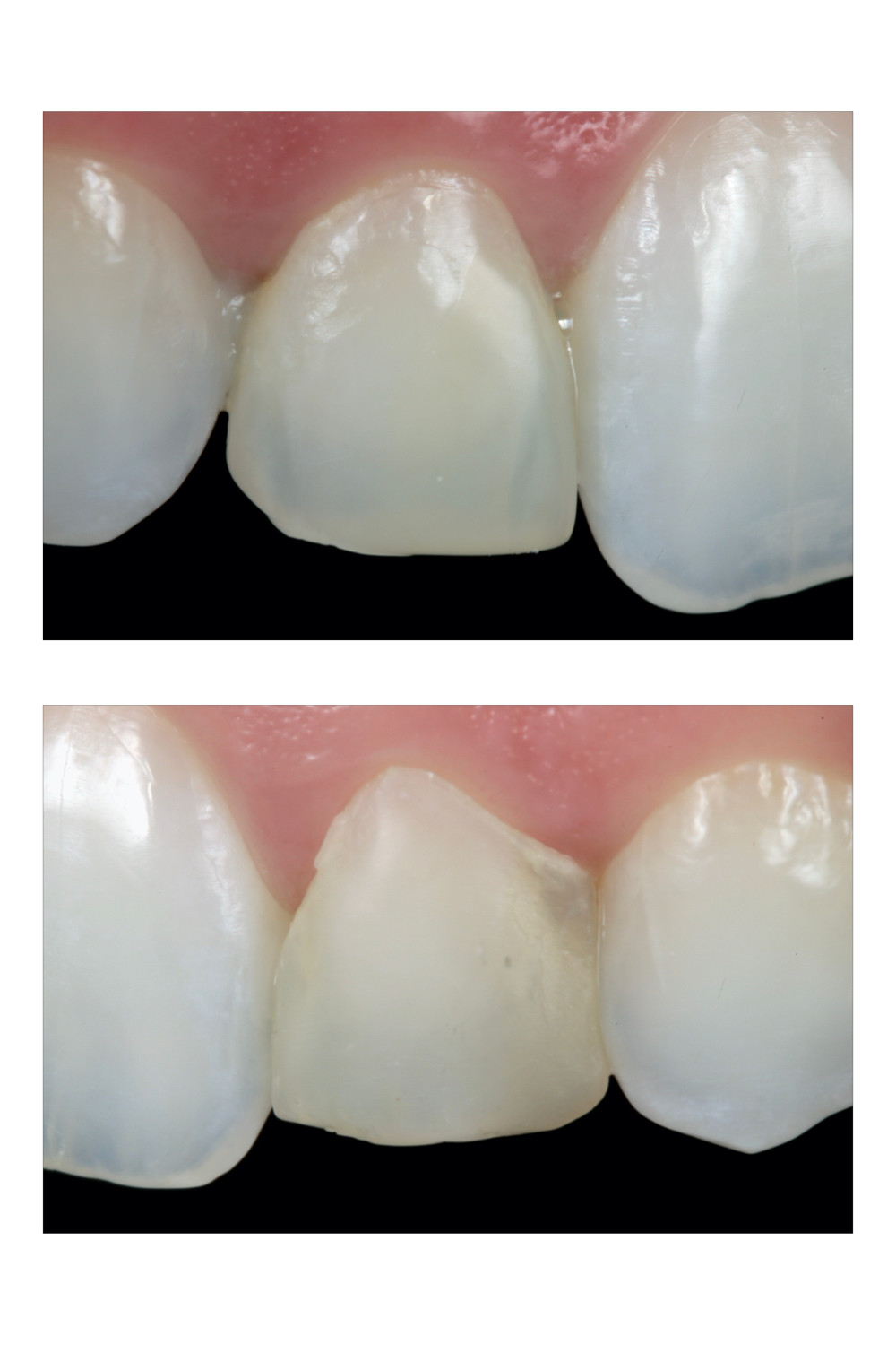 Facetas de resina composta. Daniel Malta Odontologia Estética em Florianópolis.