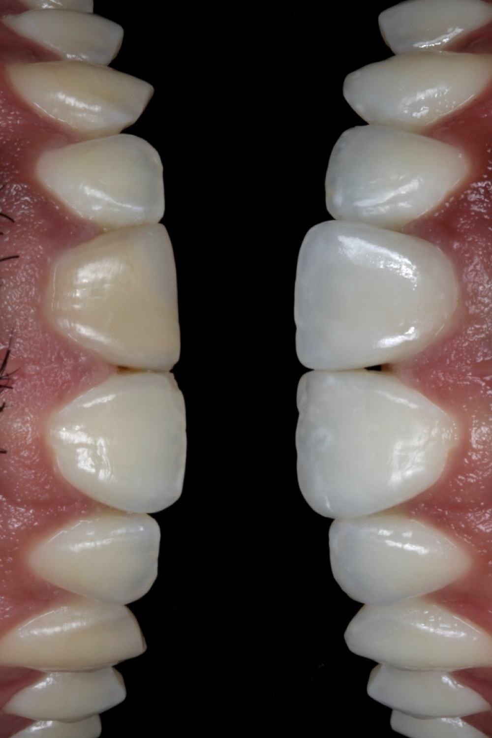 Clareamento dental seguido de resina composta e uma faceta de porcelana.