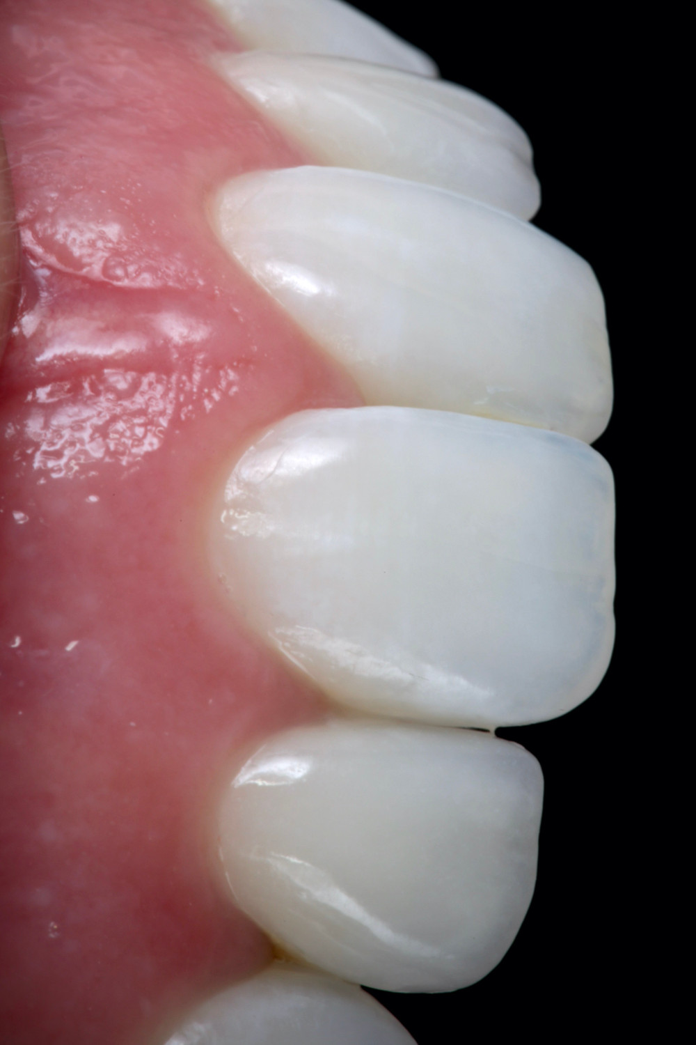 Facetas de porcelana. Daniel Malta Odontologia Estética em Florianópolis.