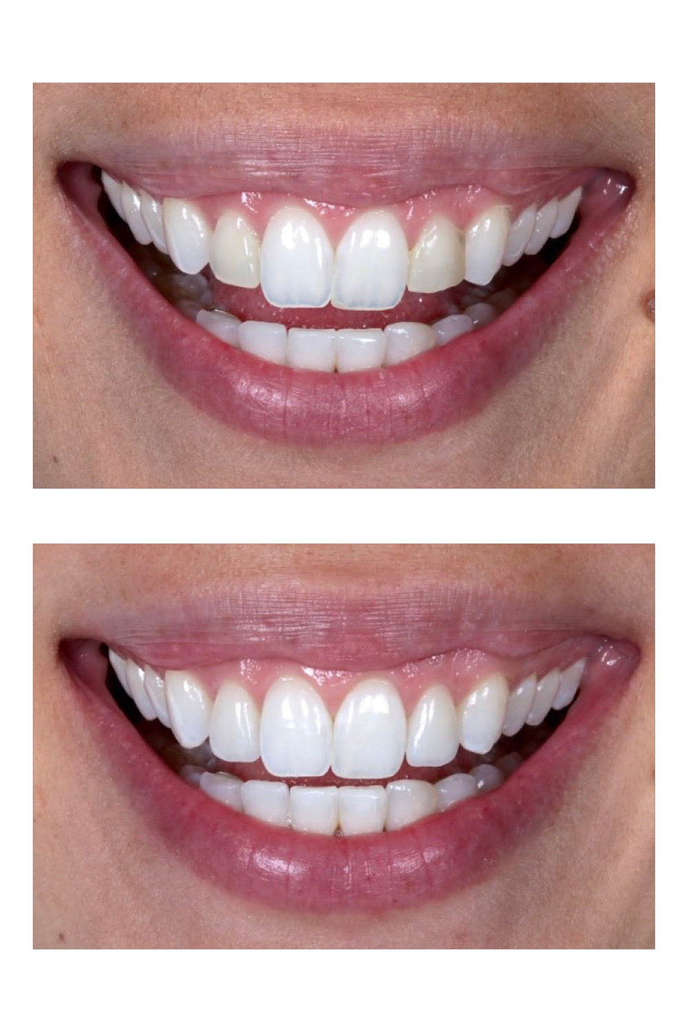 Lente de contato dental. Antes e depois. Daniel Malta Odontologia Estética em Florianopolis.