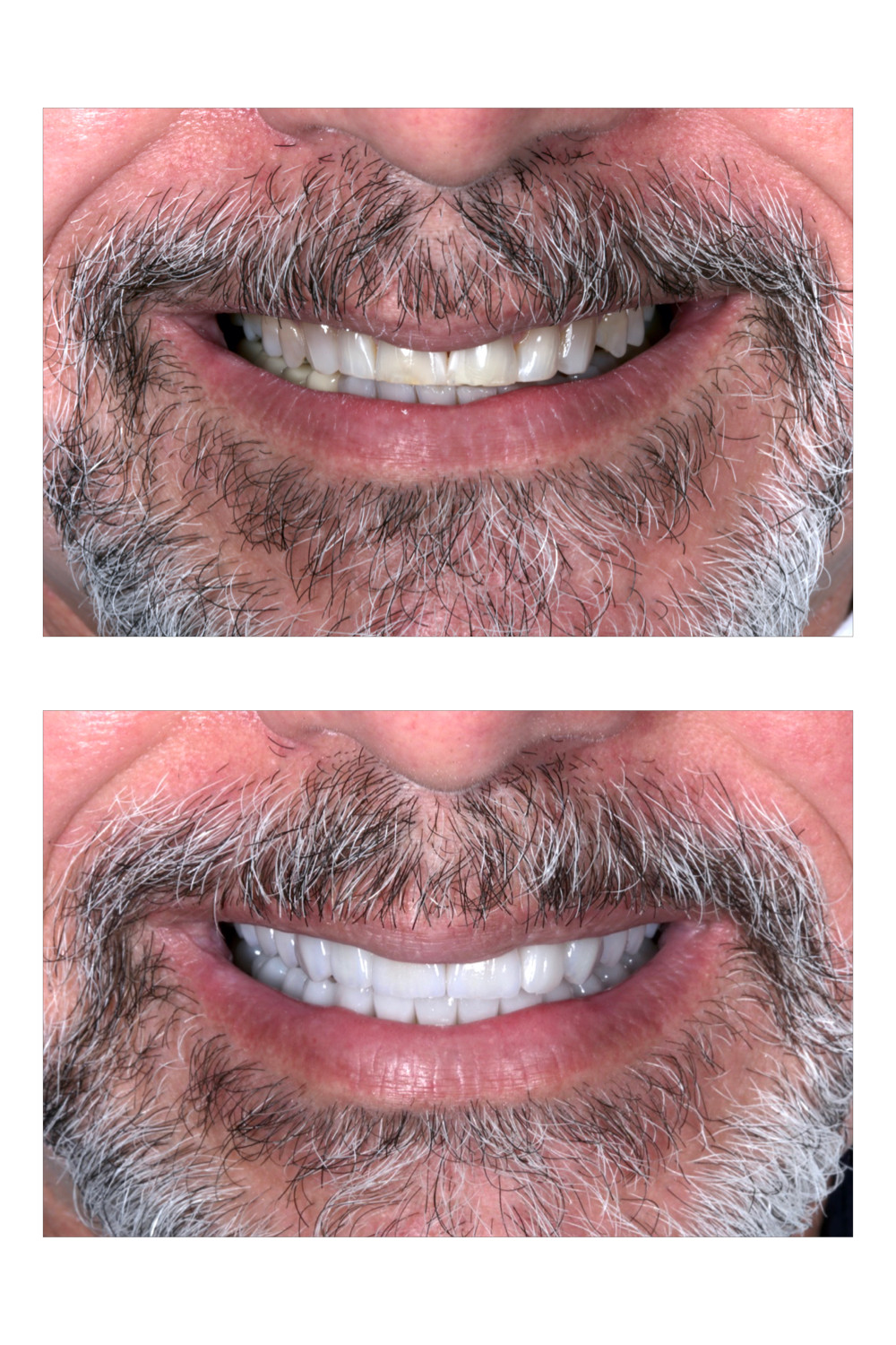 Lente de contato dental. Antes e depois. Daniel Malta Odontologia Estética em Florianopolis.