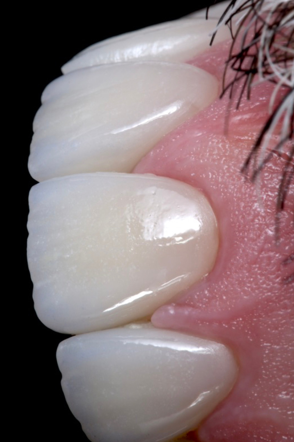 Facetas de porcelana. Daniel Malta Odontologia Estética em Florianópolis.