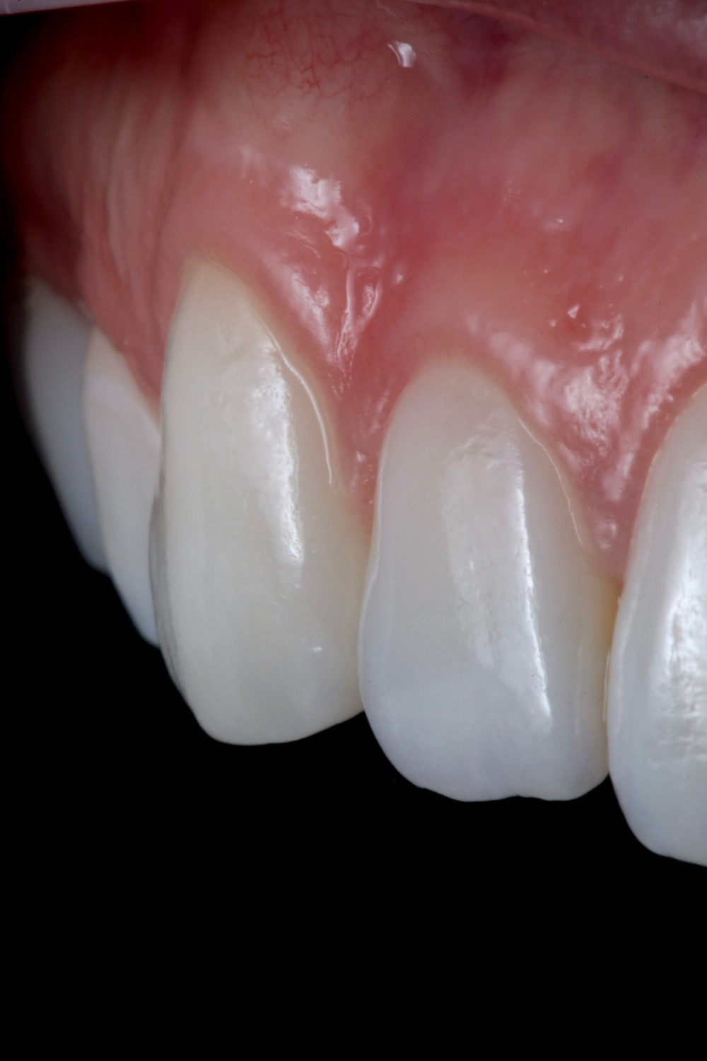 Facetas de porcelana. Daniel Malta Odontologia Estética em Florianópolis.