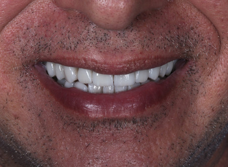 Escurecimento por tetraciclina | Reabilitação estética e funcional