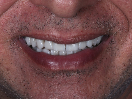 Escurecimento por tetraciclina | Reabilitação estética e funcional