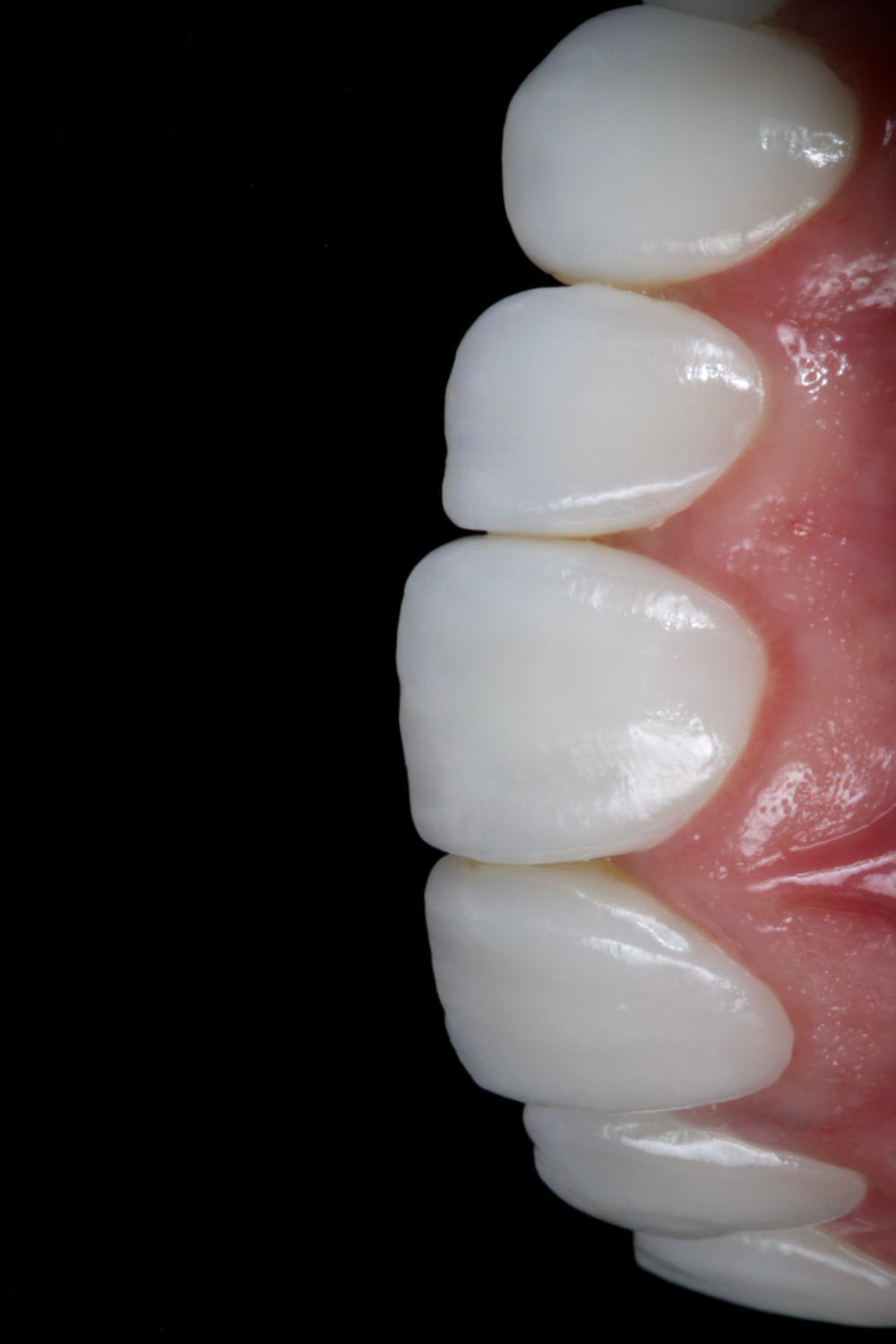 Facetas de porcelana. Daniel Malta Odontologia Estética em Florianópolis.