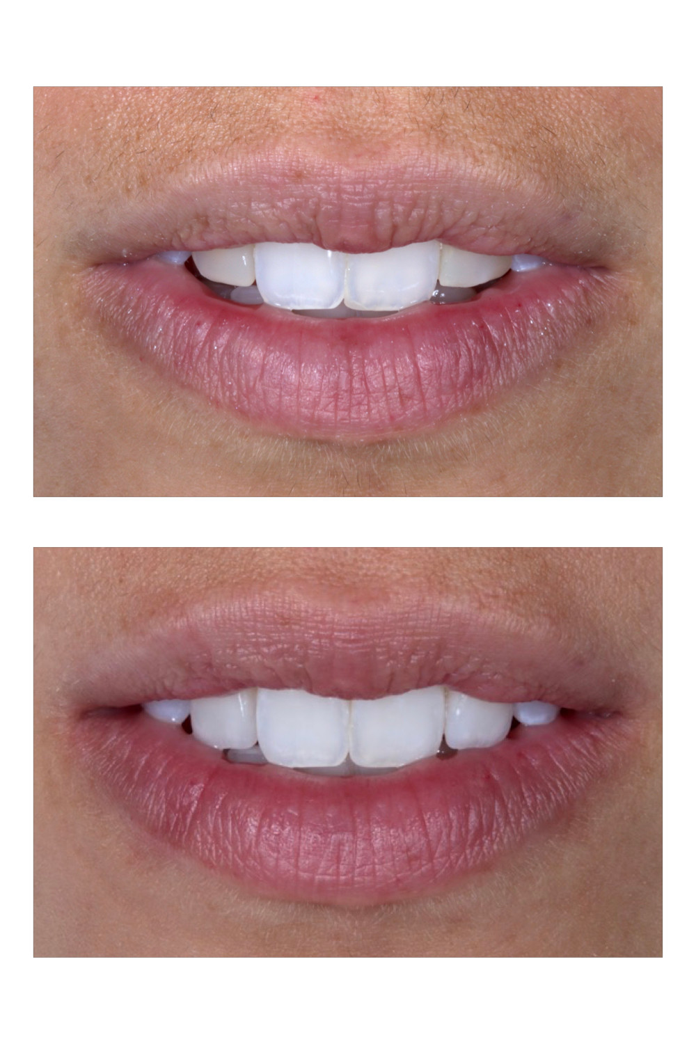 Antes e depois. Facetas de porcelana. Daniel Malta Odontologia estetica em florianopolis.