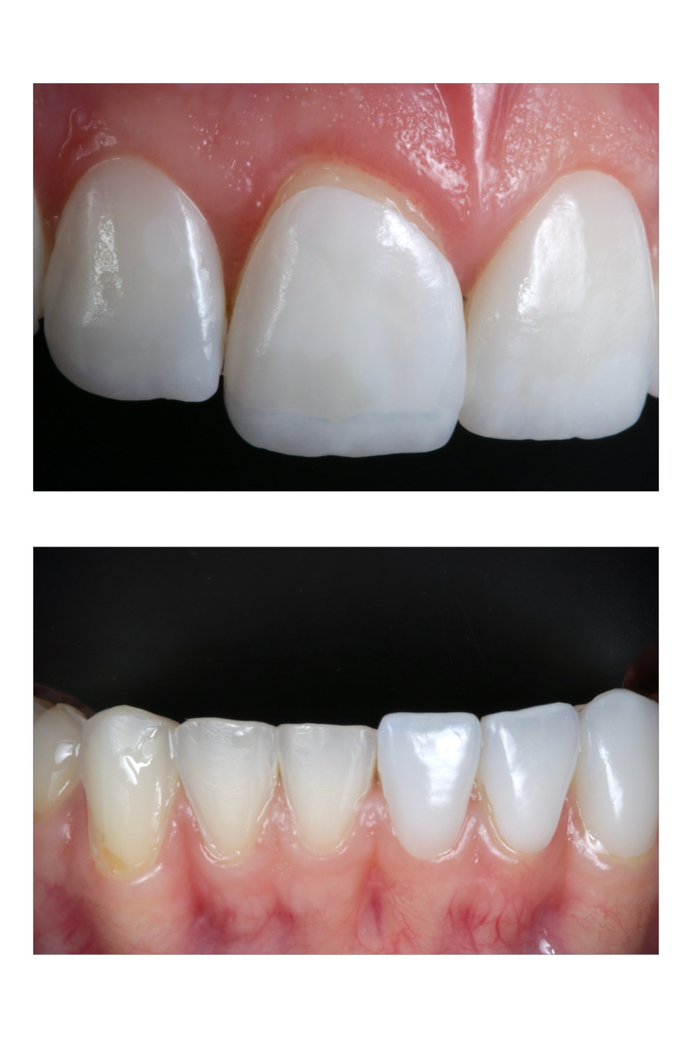 Facetas de porcelana. Daniel Malta Odontologia Estética em Florianópolis.
