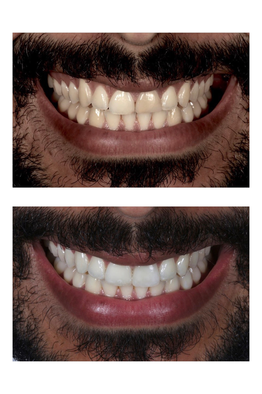 Lente de contato dental