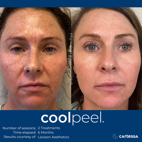 Before and after CoolPeel CO₂ laser results showing smoother, rejuvenated skin