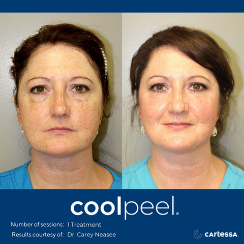 CoolPeel treatment results on female patient with refined pores and improved tone