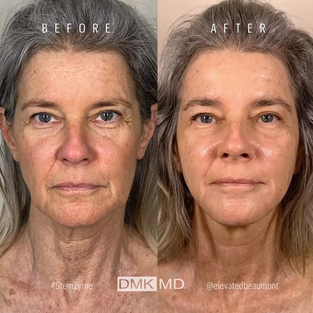 Before and after photos of a women participating in the StemZyme Program.