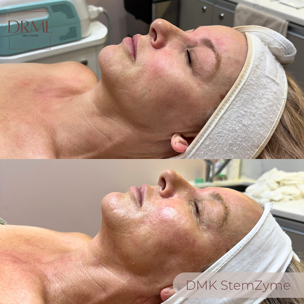 A picture of a women on day 50 of her StemZyme treatment lying on facial bed with improvments to the look and texture of her skin.