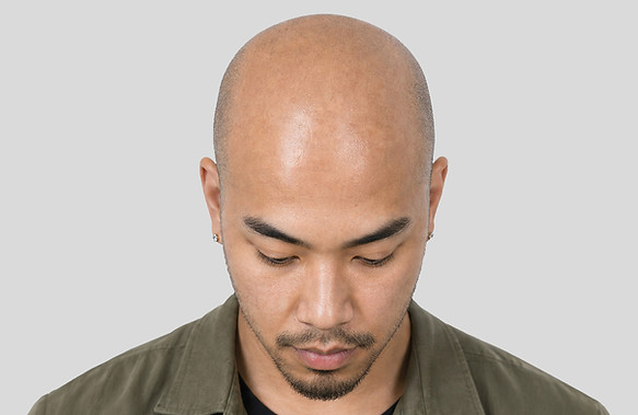 Vorher Bild eines Mannes mit sichtbarem Haarverlust vor dem Shave Effect mit SMP Kopfhautpigmentierung bei SCALP AESTHETIC in Altdorf, Schweiz.