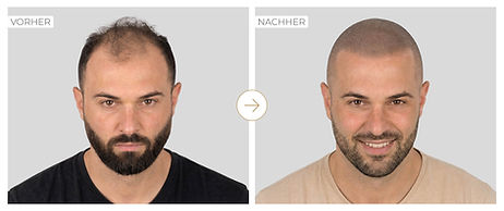 Vorher Nachher Bild eines Mannes mit fortgeschrittenem Haarausfall und natürlichem Shave Effect durch SMP in Uri.