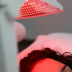 Seance de microneedling capillaire pour stimuler la repousse des cheveux dans l Oise.