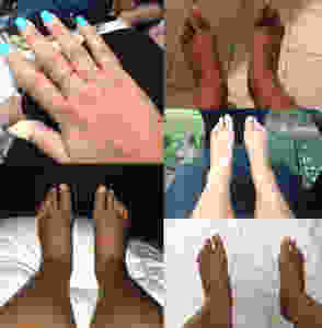 Naimah's swollen legs and hands