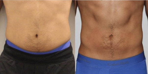 Cryo T-Shock | Anti-Cellulite Slimming and Toning - Broward