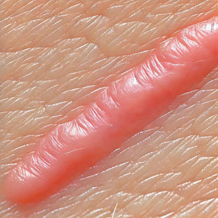 Keloid with red swelling