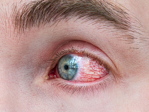 Acanthamoeba keratiti