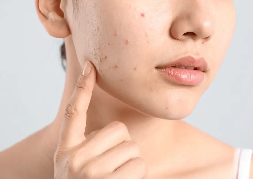 fungal acne