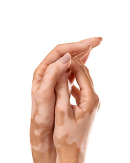 Vitiligo ohne HG.jpg