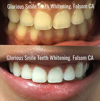 Before and After Teeth Whitening