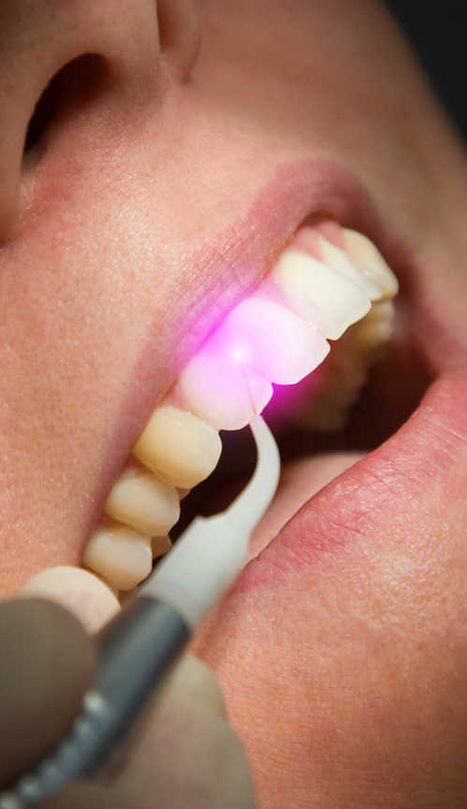 terapia laser assistita_studio dentstico dottor andrea simeone piacenza.jpeg