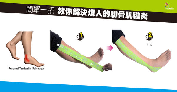 簡單一招 教你解決煩人的腓骨肌腱炎
