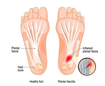 Plantar Fasciitis comparison with Normal