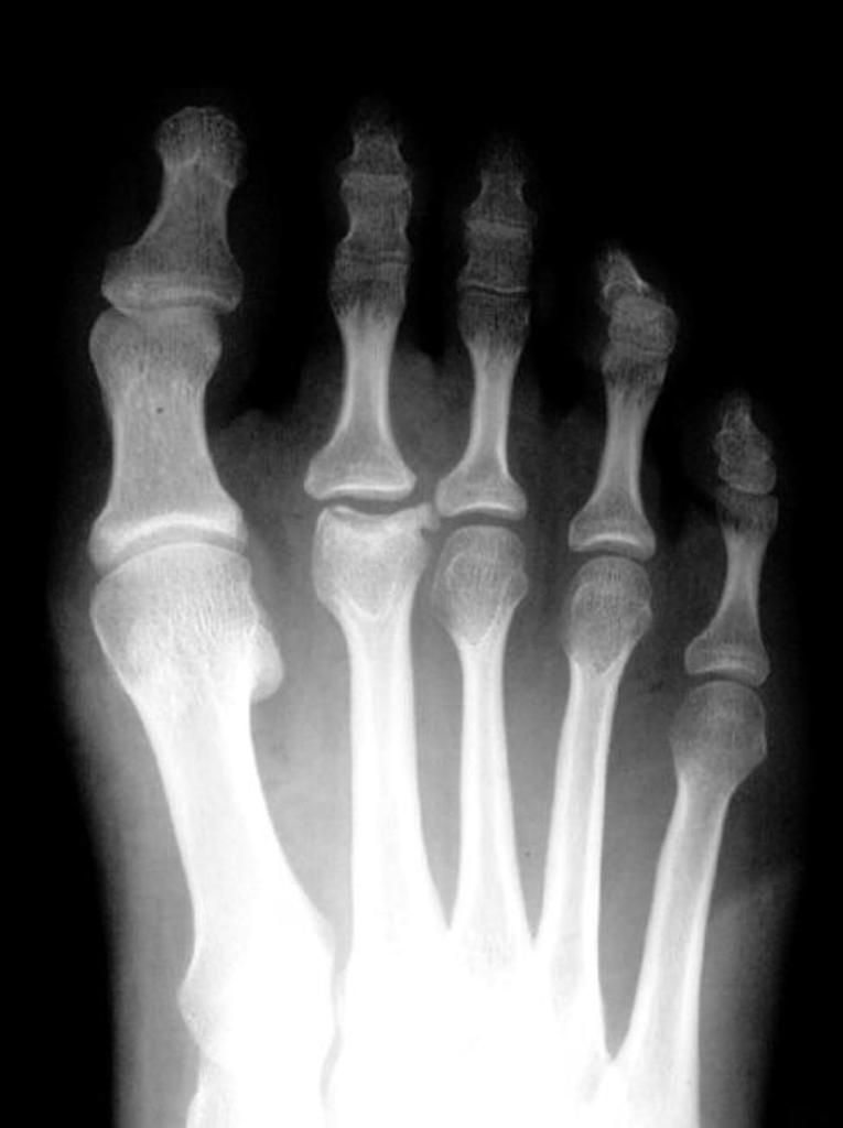 Case courtesy of Radswiki, Radiopaedia.org, rID 11436