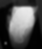 Case courtesy of Dr Mark Holland , Radiopaedia.org, rID.22865