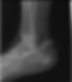 Tongue Type Fracture