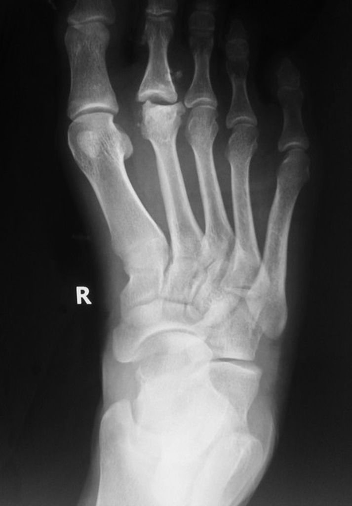 Case courtesy of Dr Ahmed Abd Rabou, Radiopaedia.org, rID 31251