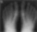 Hallux Valgux After Correction