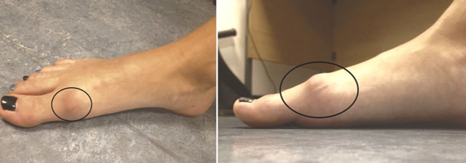 hallux-rigidus_edited.jpg