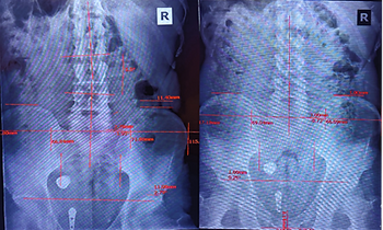 A chiropractor performing a precise spinal adjustment on a patient, emphasizing the science-backed approach of chiropractic care in addressing misalignments and promoting improved health and wellness.