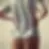 Side view of a man with hyperlordosis, highlighting the excessive inward curvature of the lower spine. Her posture demonstrates the impact of hyperlordosis on spinal alignment and lower back health.