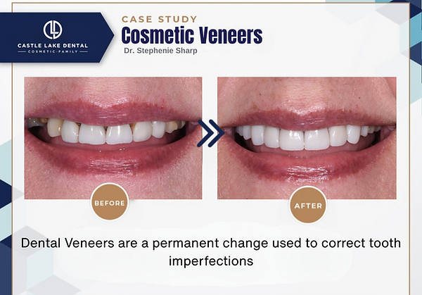 cosmetic veneers.png