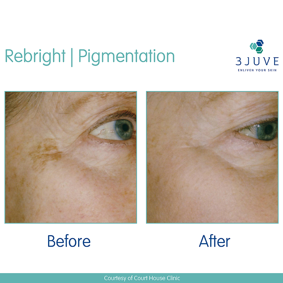 Before and after pigmentation