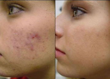 Acne Care