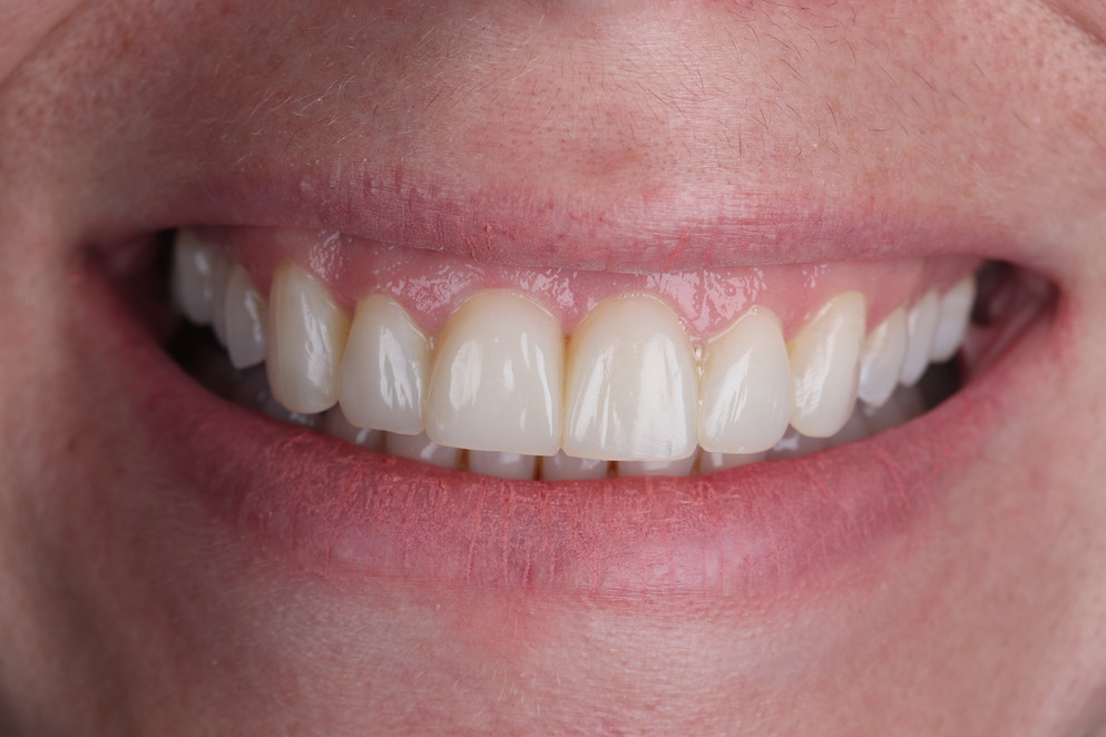 composite-bonding-monument-dental