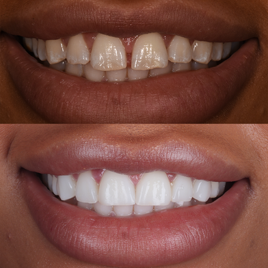 Before and After Composite Bonding Monument Dental Studio