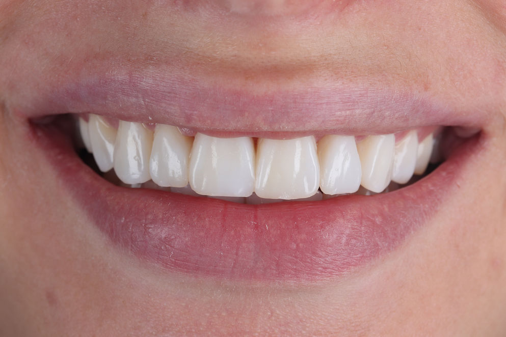 Composite Bonding After