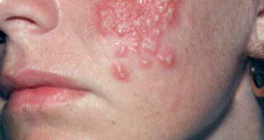 herpes