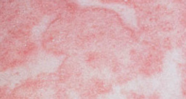 what is skin cancer, how is skin cancer diagnosed, cutaneous paraneoplastic syndrome, basal cell carcinoma, squamous cell carcinoma, melanoma, Merkel cell carcinoma