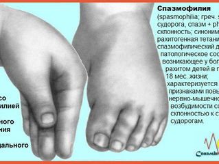 СПАЗМОФИЛИЯ У ДЕТЕЙ