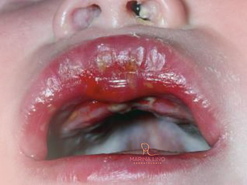 Sintomas e diagnóstico do herpes em bebês