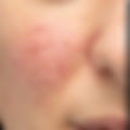 Before and after laser treatment for rosacea, couperose_edited.jpg